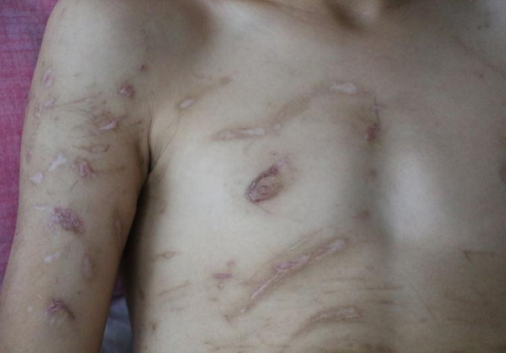 Köpek saldırısına uğramıştı! 9 operasyon geçirdi ama yetmedi