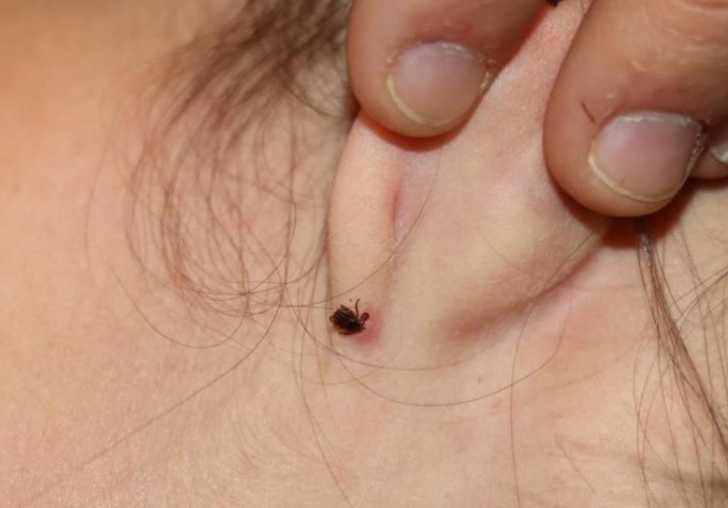 Kulağına Kene Yapışan Çocuk Hastanelik Oldu