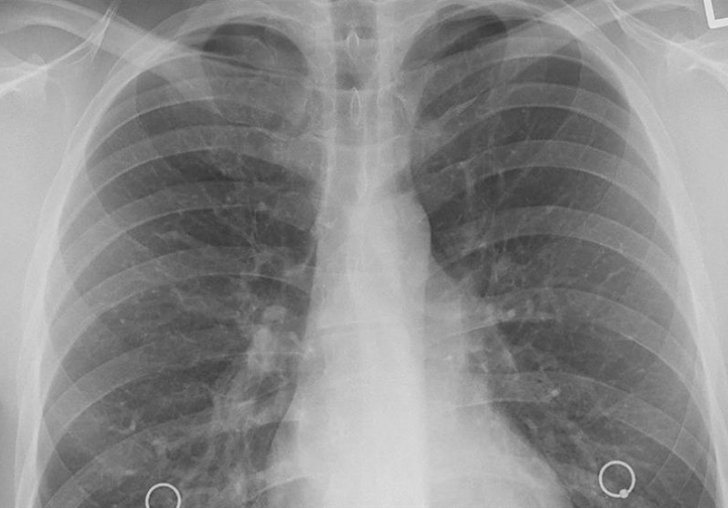 Yılda 35 Bin Akciğer Kanseri Tanısı